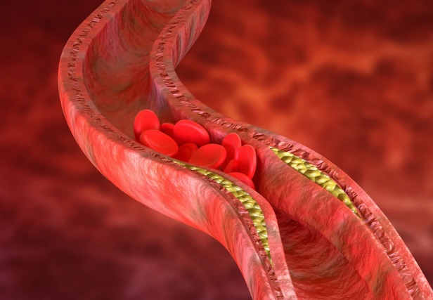  Meta de colesterol: saiba como ela deve ser definida e a importância do controle